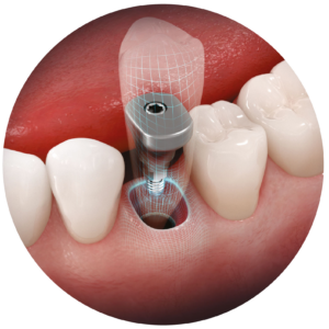 Anatomic Healing Abutments
